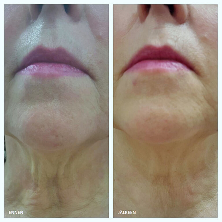 Caretech-HIFU-ennen-ja-jälkeen-BeautyQ