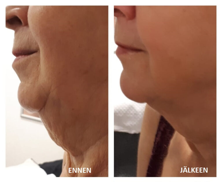 Caretech-HIFU-hoito-ennen-ja-jälkeen-BeautyQ 1