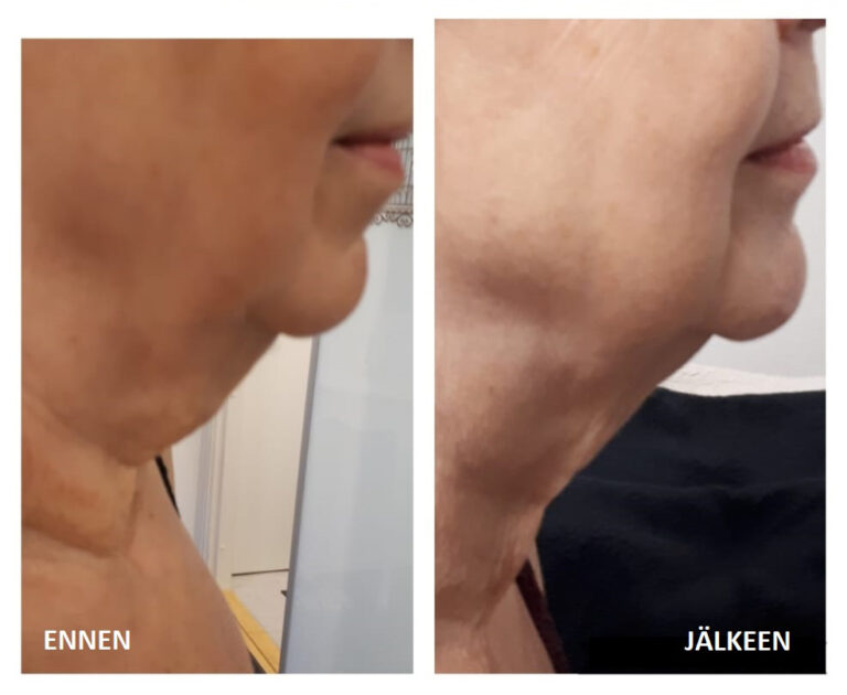 Caretech-HIFU-hoito-ennen-ja-jälkeen-BeautyQ
