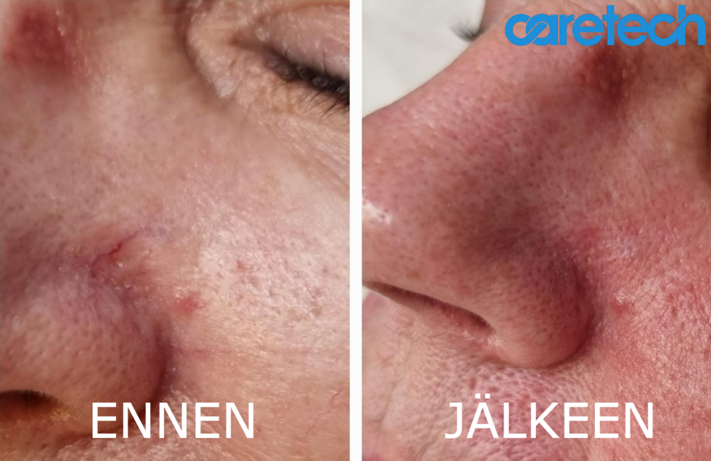 BeautyQ ennen ja jälkeen Vasen logo nenän yläosa