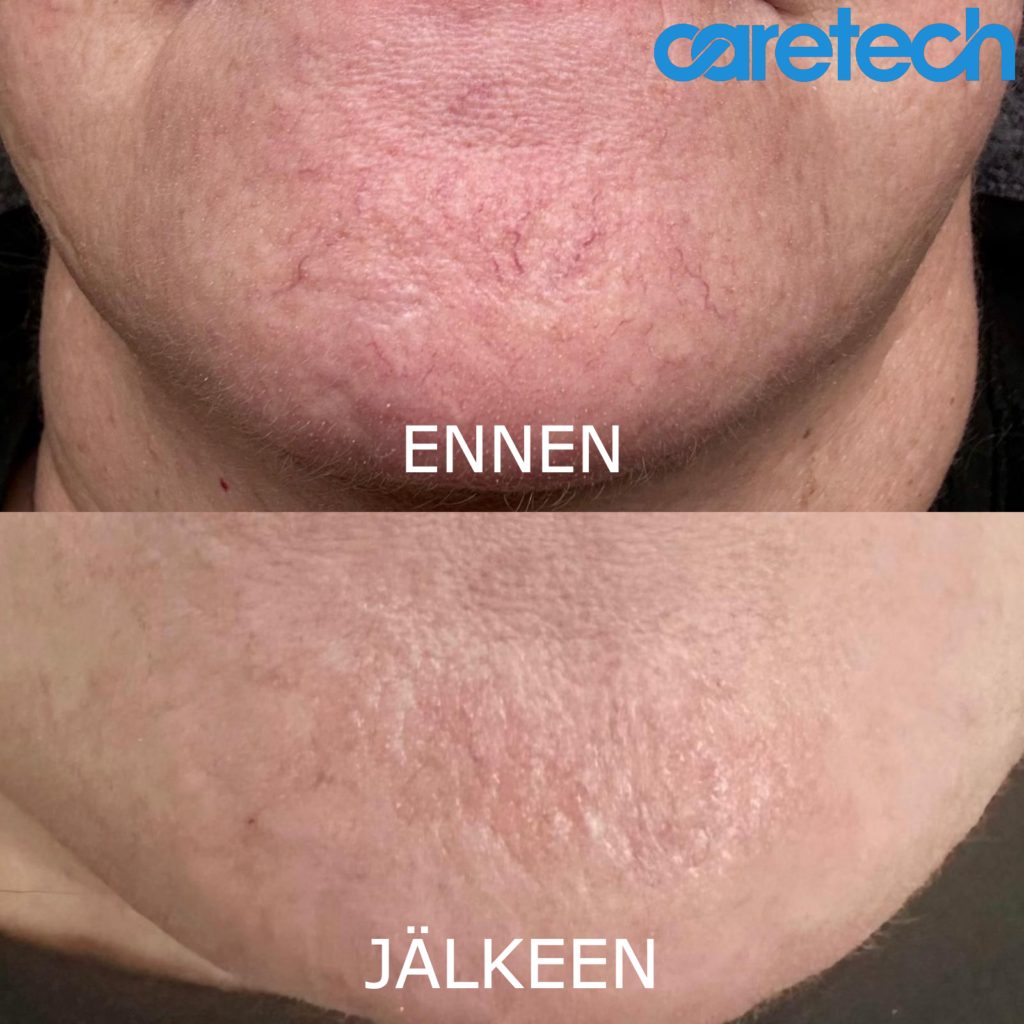 Ihana Valo Varkaus enne ja jälkeen logo